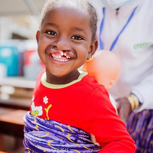 Help Fund Cleft Lip or Cleft Palate Surgery